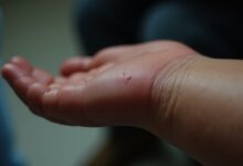 Travailler malgré une rupture du tendon supra-épineux : jusqu&rsquo;où peut-on aller ?
